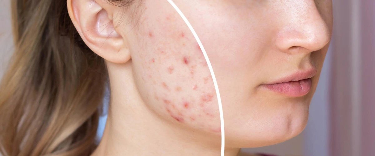Acne Scars Treatment