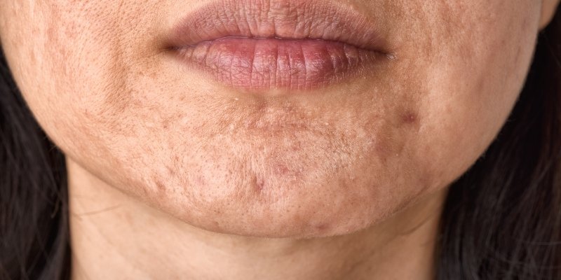 Boxcar Scars Treatment