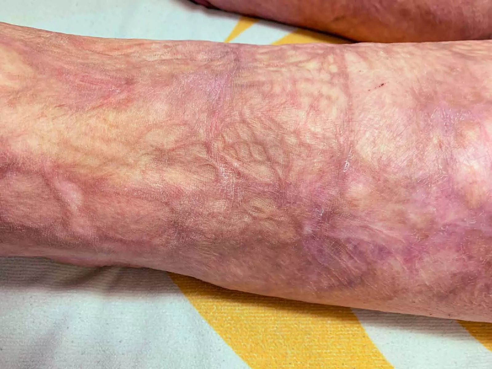 Burn Scars Treatment