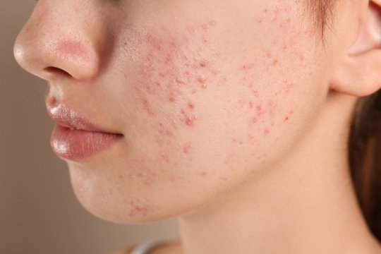 Ice Pick Scars Treatment