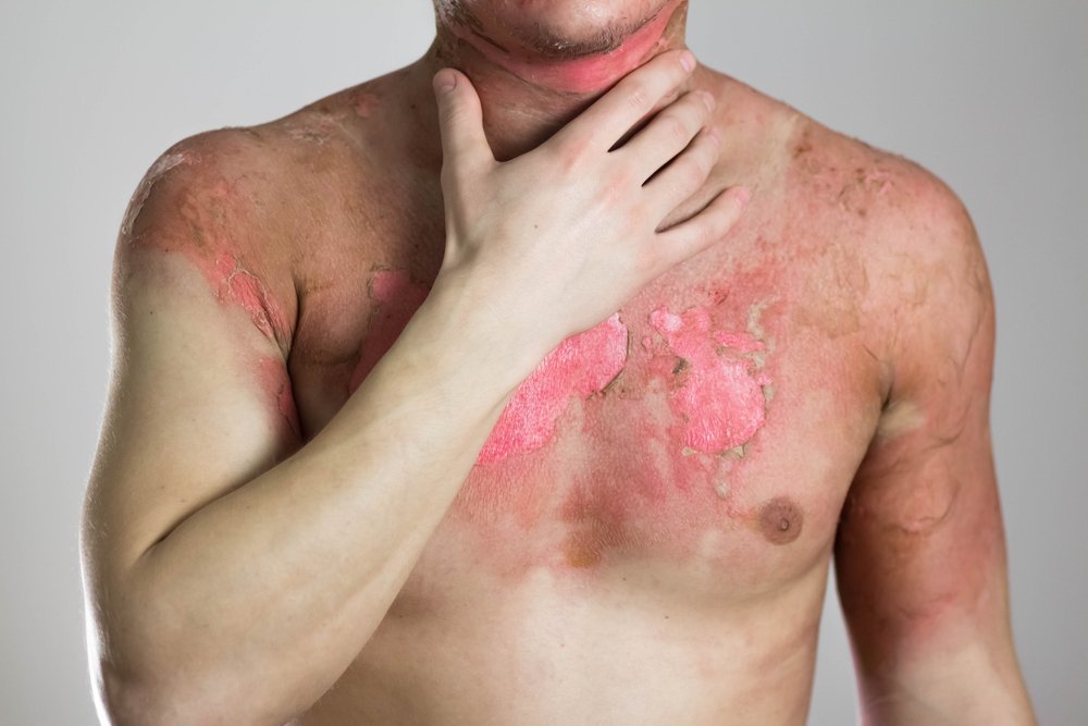 Injury Scars Treatment