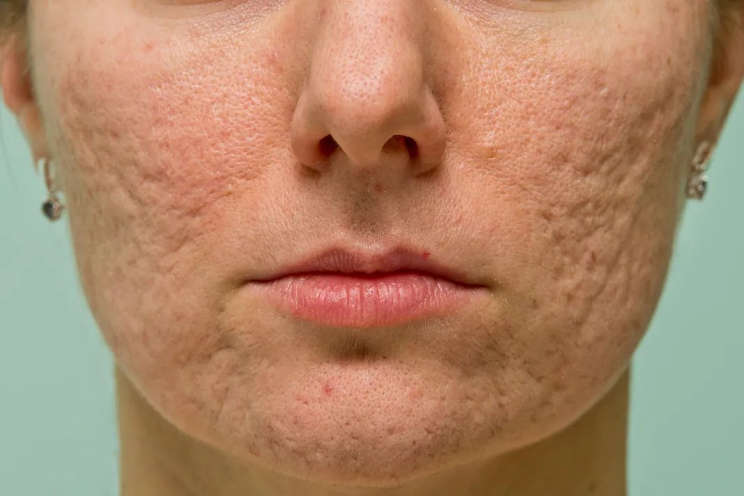 Rolling Scars Treatment