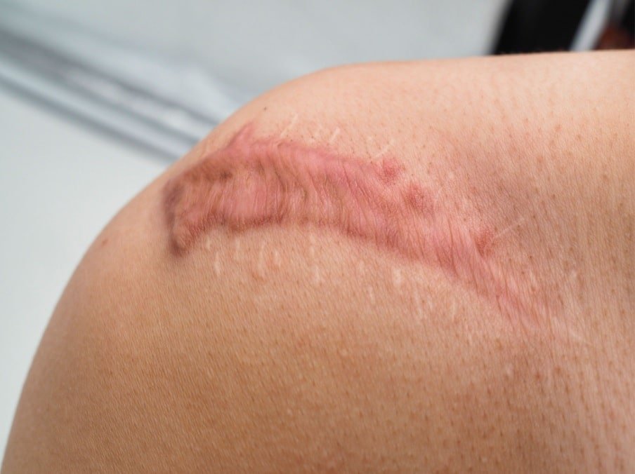 Surgical Scars Treatment