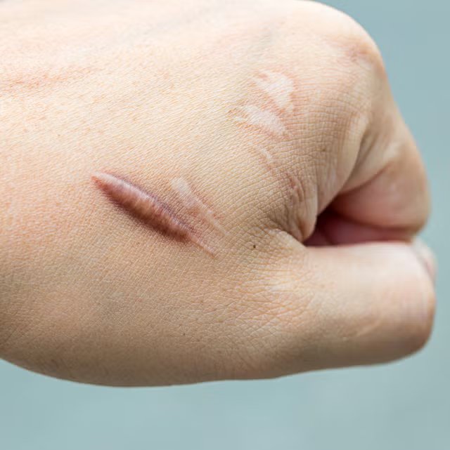 Scar Assessment