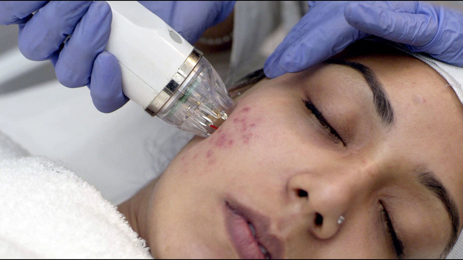 Microneedling RF