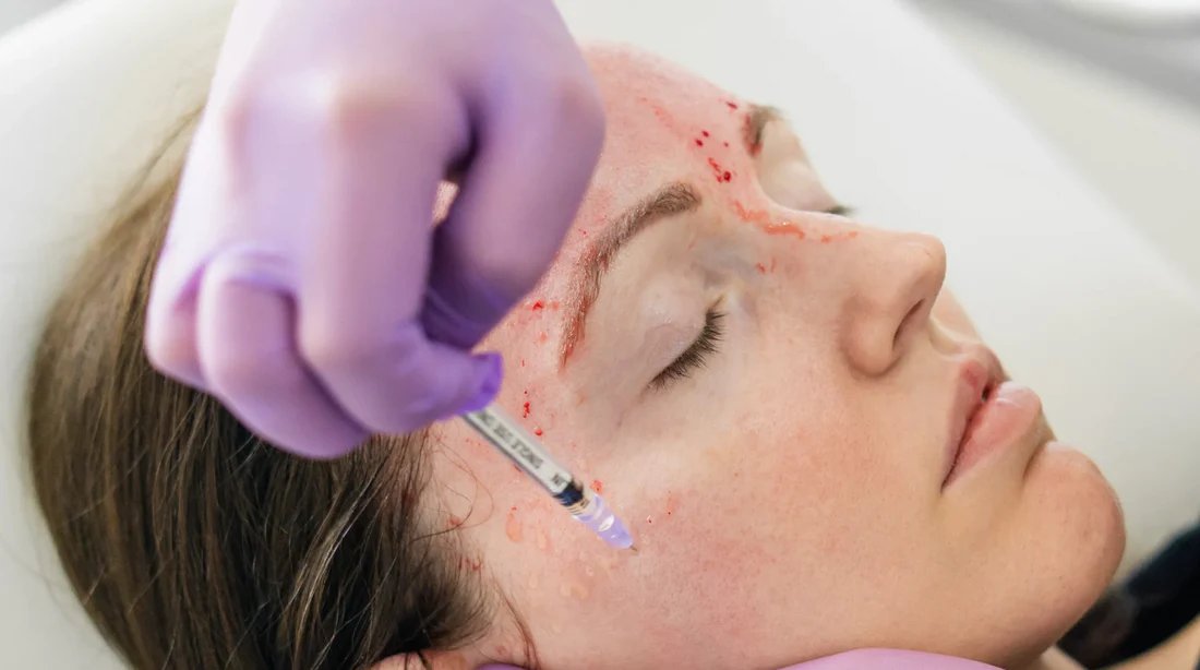 PRP Therapy